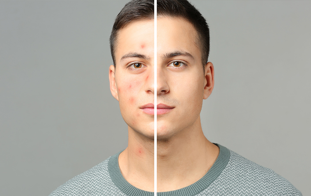 Man showing before-and-after: one half of his face clear after an acne facial, the other half has blemishes and irritation.