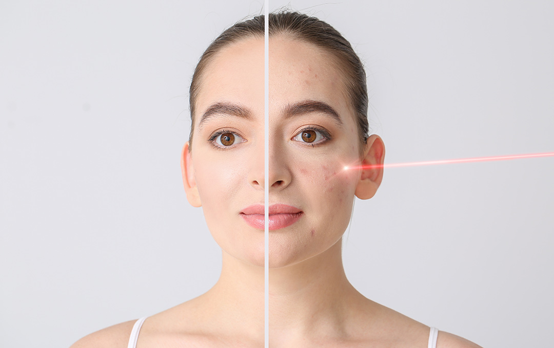 A woman’s face split to show laser facial results: 'after' side bright and smooth; 'before' side pale with red bumps and breakouts.