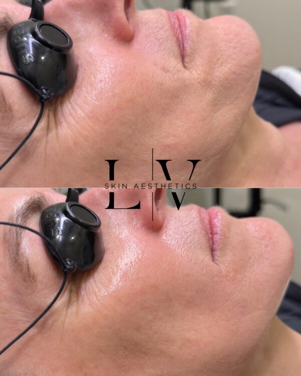 Hydrafacial Summer Reset $179 - Image 2