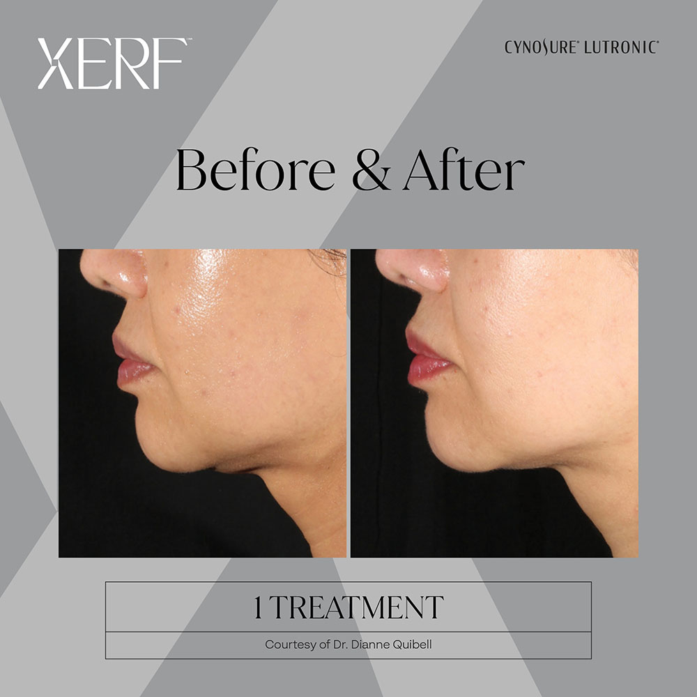 XERF: Full Face and Neck - Image 4