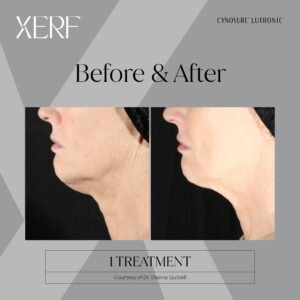 XERF Full Face and get Free Neck
