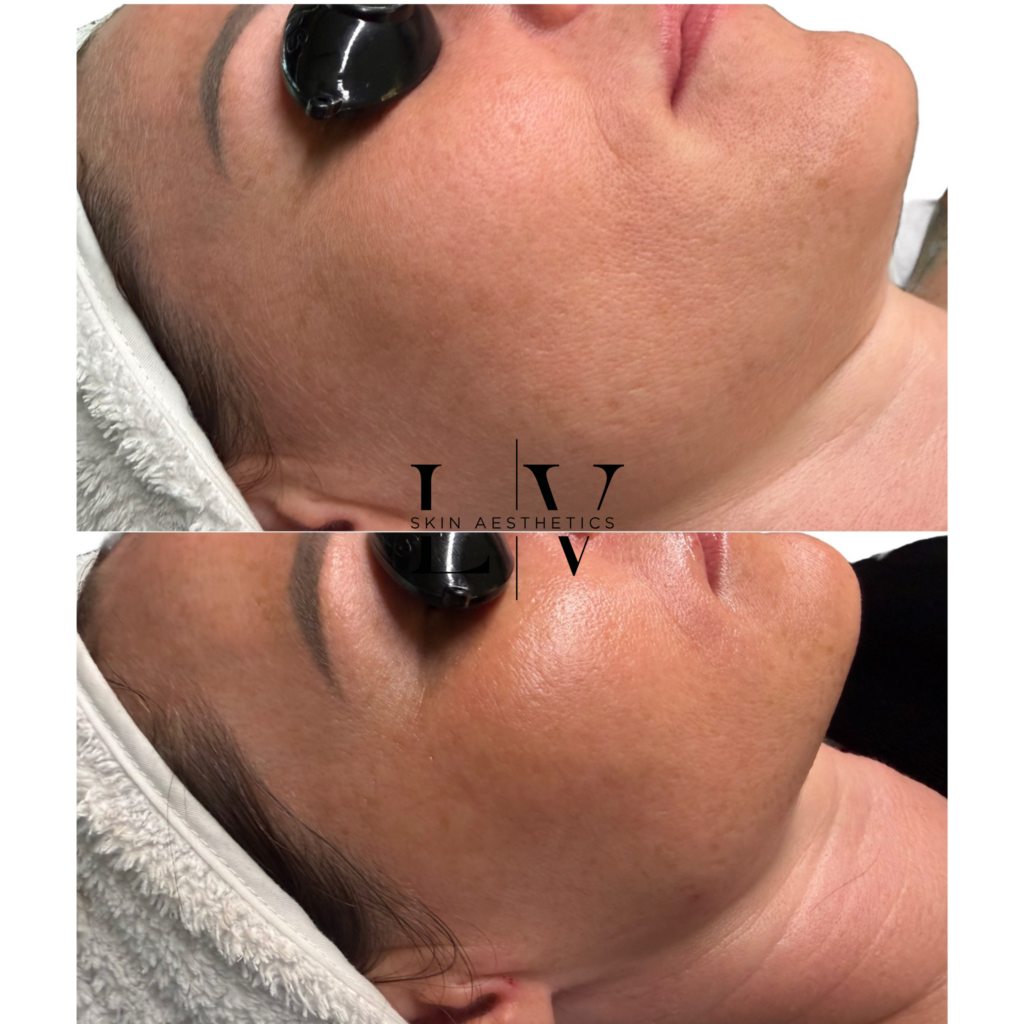 BioRepeel Deluxe: includes Dermaplaning