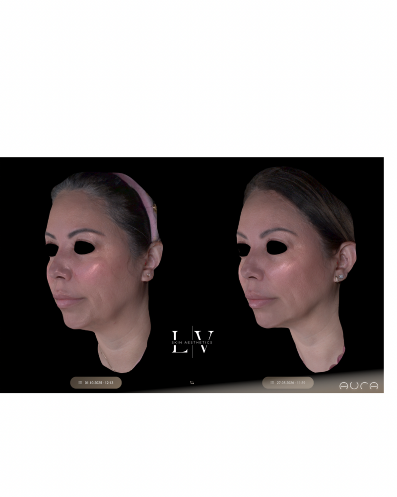 XERF: Full Face and Neck - Image 2