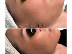 BioRepeel Deluxe: includes Dermaplaning