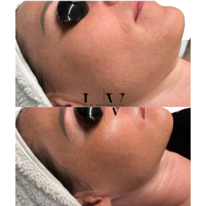 BioRepeel Deluxe: includes Dermaplaning
