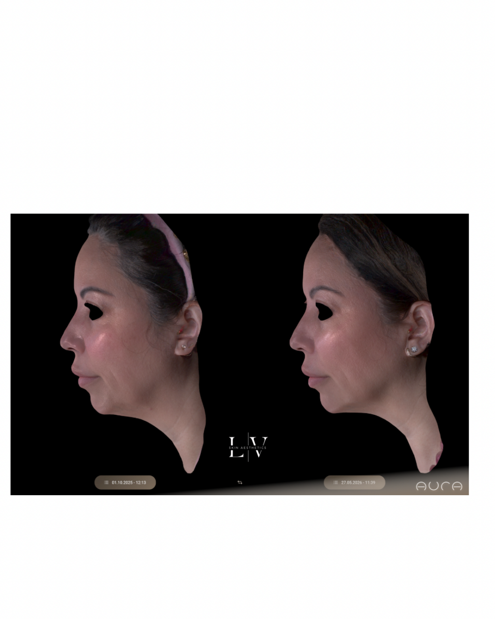 XERF: Full Face and Neck - Image 3