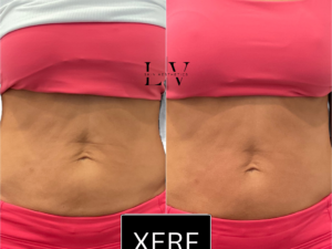 XERF: Body (Choose 1: Upper Arms, Tops of Knees, Inner Thighs, Abdomen, Glutes)