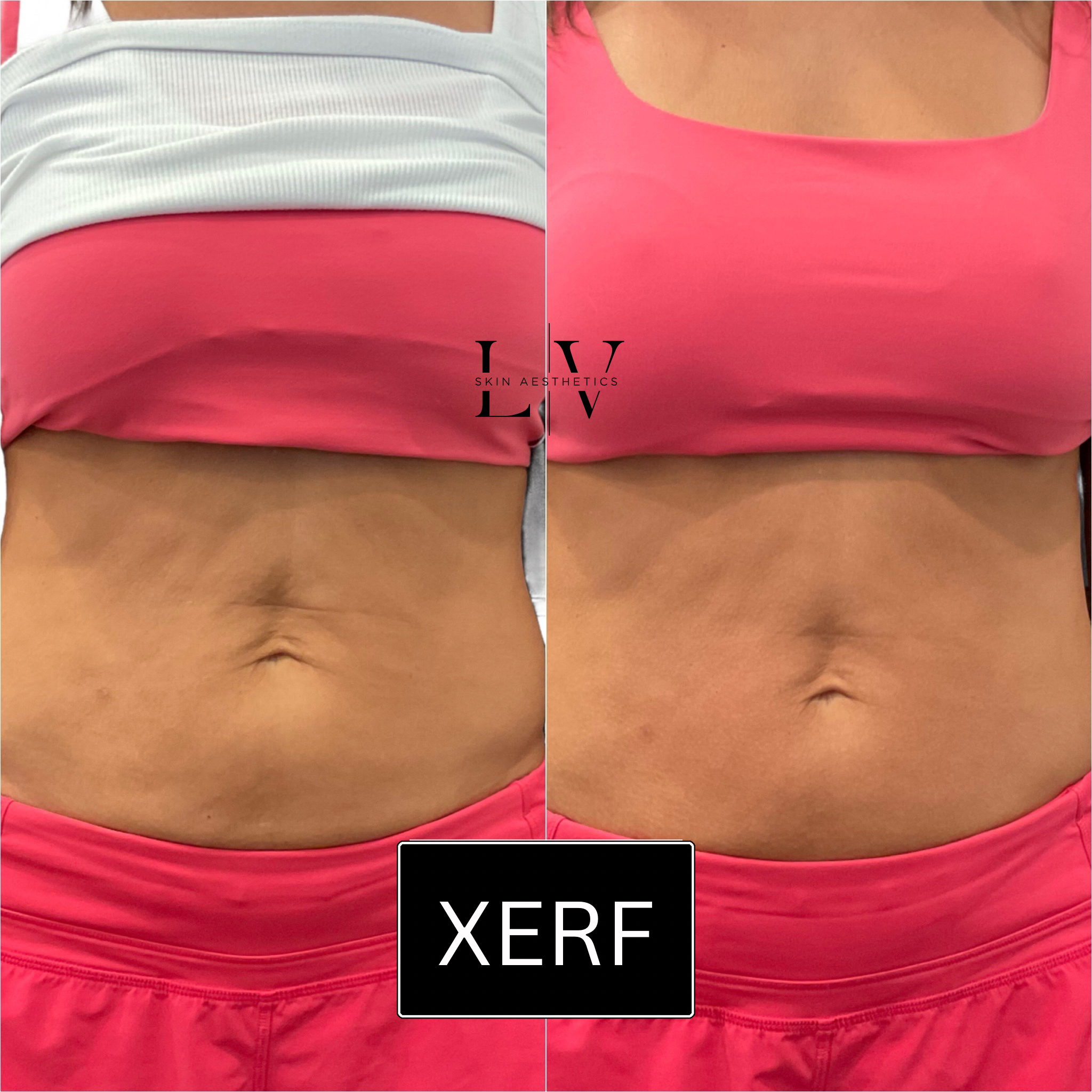 XERF: Body (Choose 1: Upper Arms, Tops of Knees, Inner Thighs, Abdomen, Glutes)
