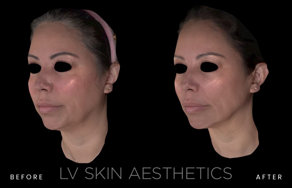 before and after of K-Luxe treatment