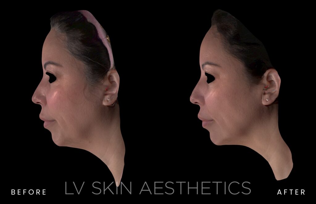 before and after of K-Luxe treatment