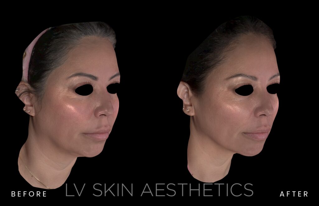 before and after of K-Luxe treatment