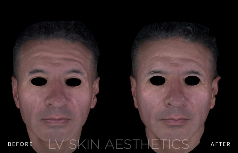 Before and after K-LUXE treatment at LV Skin Aesthetics, three-quarter view of a man’s cheek and jawline