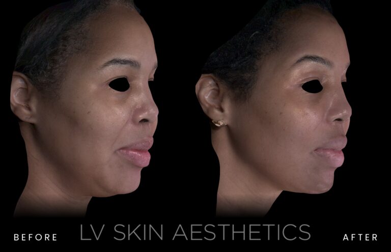 Before and after K-LUXE treatment at LV Skin Aesthetics, three-quarter view of a woman’s cheek and jawline