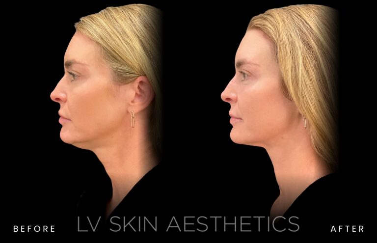 : Before and after K-LUXE treatment at LV Skin Aesthetics, three-quarter view of a woman’s face and jawline